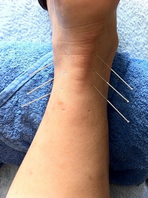 Superficial dry needling
